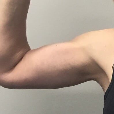 After Image of Arm Lift Cleveland