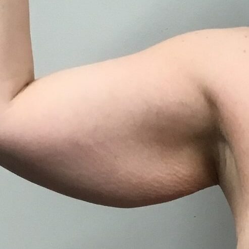 arm lift before