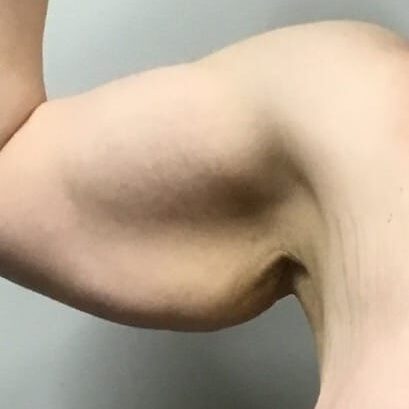 Before Image of Arm Lift Cleveland
